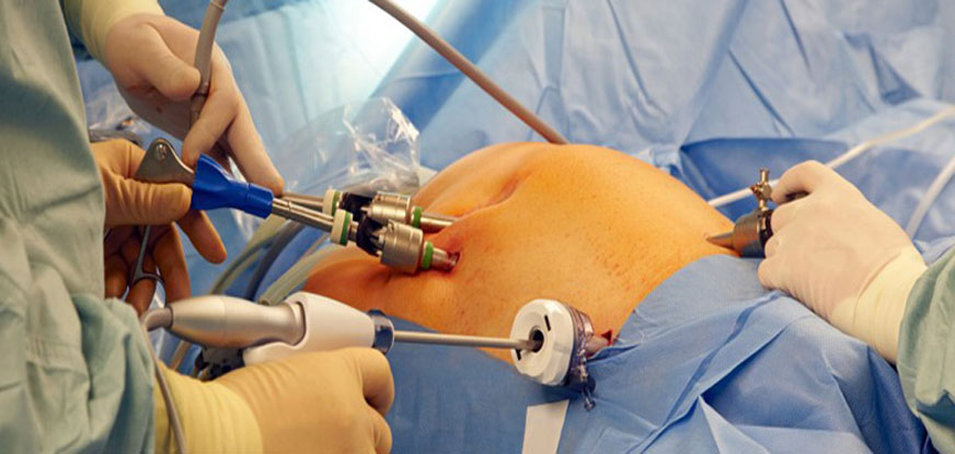 laparoscopic surgery in ahmedabad